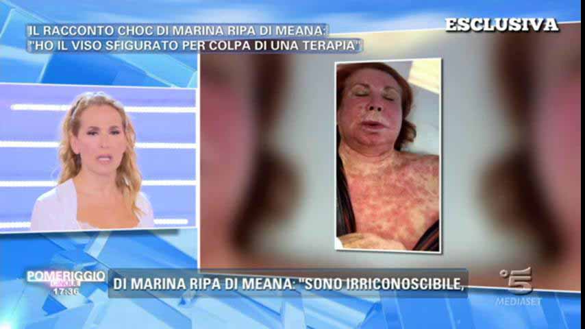 Marina Ripa di Meana volto allergia